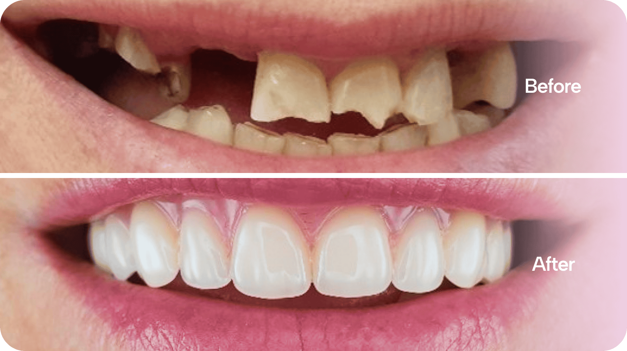 Veneers