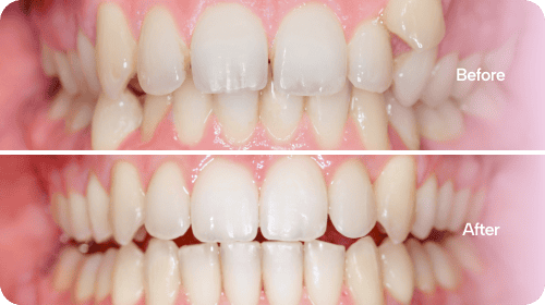 Invisalign - Before and After