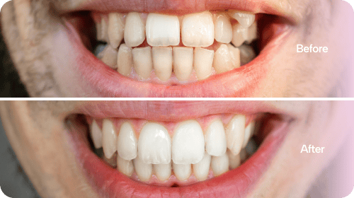 Invisalign - Before and After