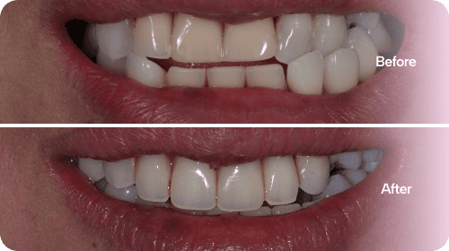 Invisalign - Before and After