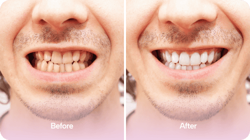 Invisalign - Before and After