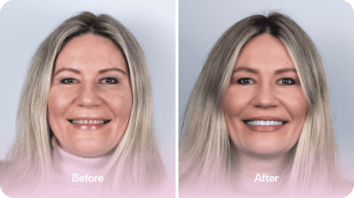 Dental Implants - Before and After