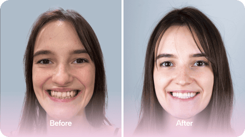 Dental Implants - Before and After