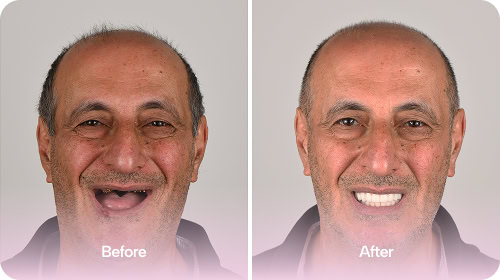 Dental Implants - Before and After