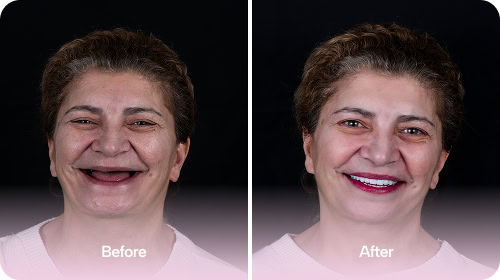 Dental Implants - Before and After